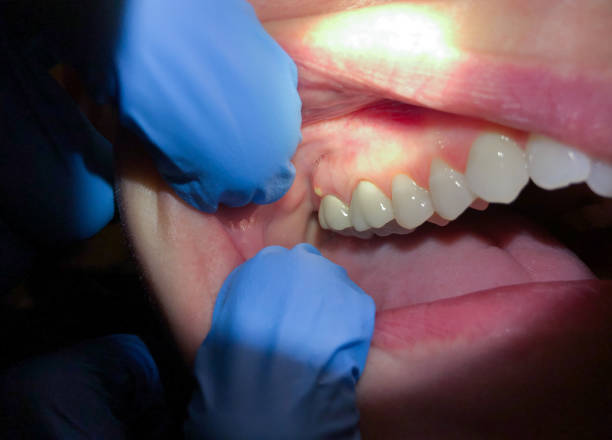 Best Emergency Denture Repair in Windsor, IL