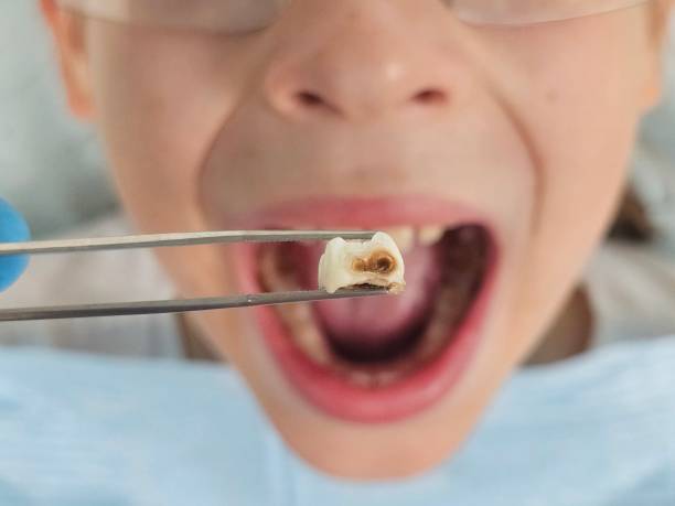 Best Emergency Dental Care for Broken or Chipped Teeth in Windsor, IL